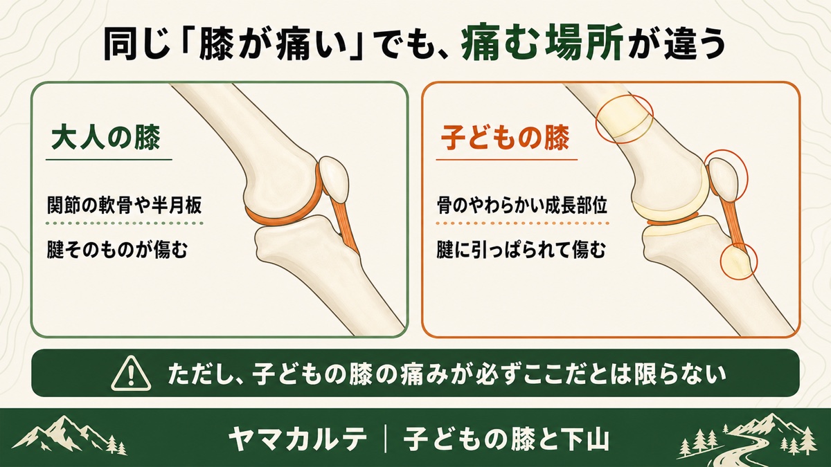 大人の膝と子どもの膝で痛む場所が違うことを示す図解 大人は関節の軟骨や半月板と腱そのものが傷むが、子どもは骨のやわらかい成長部位が腱に引っぱられて傷む ただし子どもの膝の痛みが必ずここだとは限らない ヤマカルテ